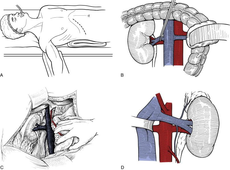 Figure 37-2, Exposure for a hepatorenal bypass. A, Patient positioning for a right subcostal incision. B through D, Exposure of the hepatic and right renal arteries for hepatorenal bypass.