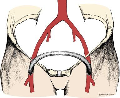 Figure 29-1, Typical configuration for femoral-femoral bypass with bilateral longitudinal groin incisions, a suprapubic subcutaneous tunnel, and a generally continuous arc to avoid kinking of the graft. Longitudinal skin incisions are generally the most versatile for this operation.