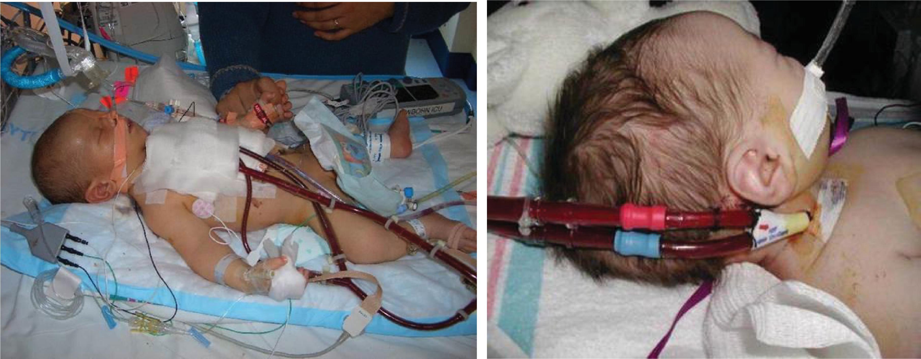 Fig. 82.1, A Patient With a Life-Threatening Congenital Cardiac Anomaly Being Treated With Veno-Arterial Extracorporeal Membrane Oxygenation .