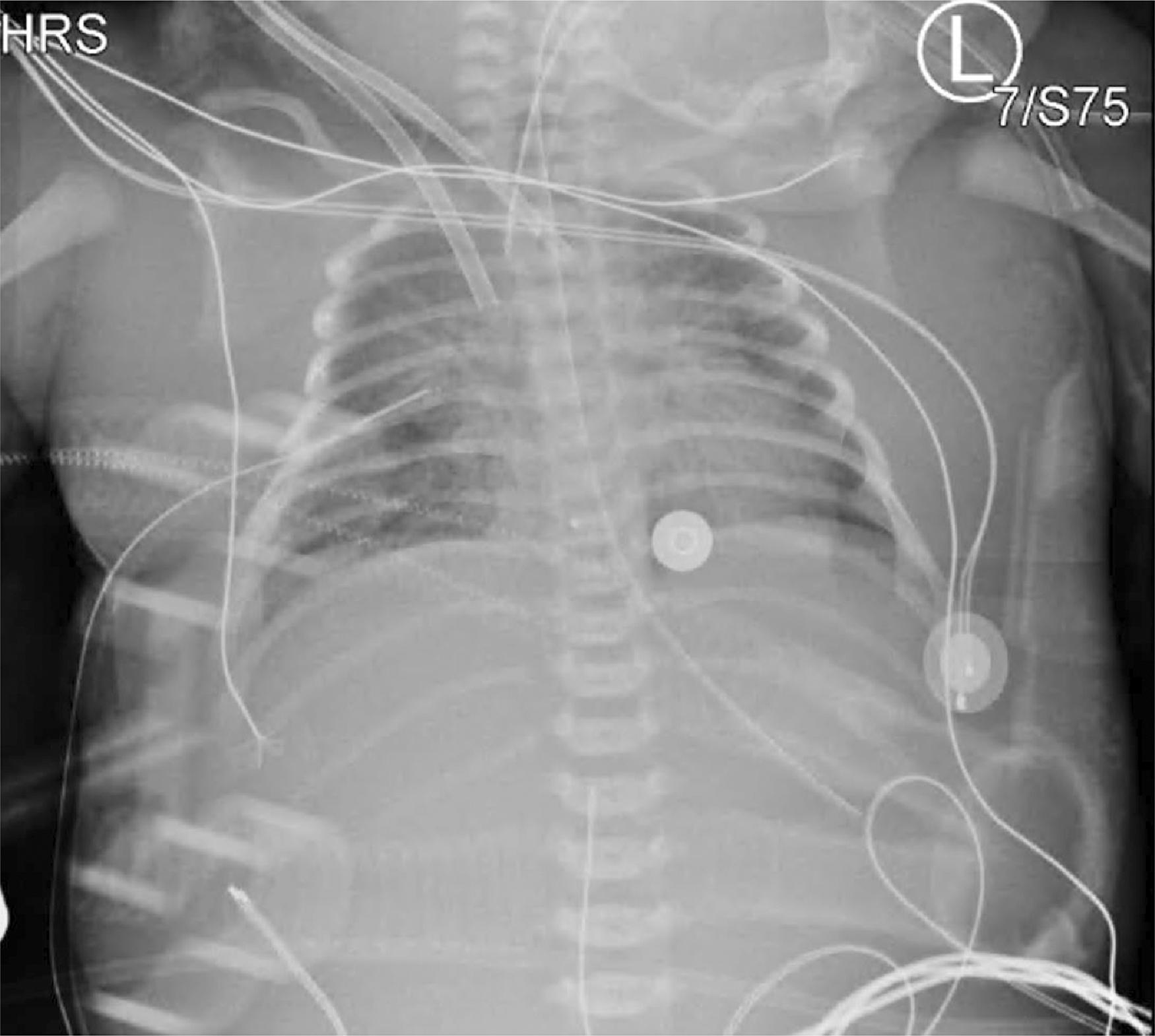 Fig. 82.2, Chest X-Ray of a Neonate Being Treated With Extracorporeal Membrane Oxygenation .
