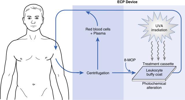 Fig. 24.1, Extracorporeal photochemotherapy. Blood is accessed via a 16-gauge needle in a peripheral vein, heparinized, and collected by the extracorporeal photopheresis (ECP) unit. UVADEX (8-methoxy-psoralen; 8-MOP) is automatically injected into ECP unit at an appropriate dose. The patient undergoes discontinuous pheresis cycles to separate out the leukocyte-rich buffy coat, which is eventually fed through a one-cell-thick transparent cassette for exposure to ultraviolet A light in the presence of 8-MOP. These photochemically altered cells are then reinfused, as are the previously separated red blood cells and plasma. The entire procedure takes approximately 3 hours ∗ . The treatment is typically repeated a second day, and this 2-day cycle is typically repeated monthly. ∗ Now 1.5 hours with Cellex.