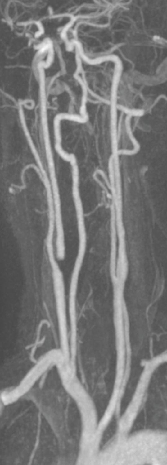 Figure 10.1, Contrast-enhanced magnetic resonance angiography in the right anterior oblique orientation providing overview anatomical imaging, i.e. from the arch origin to the circle of Willis. There is an extremely tight stenosis (>95%) at the right carotid bulb/proximal internal carotid artery.