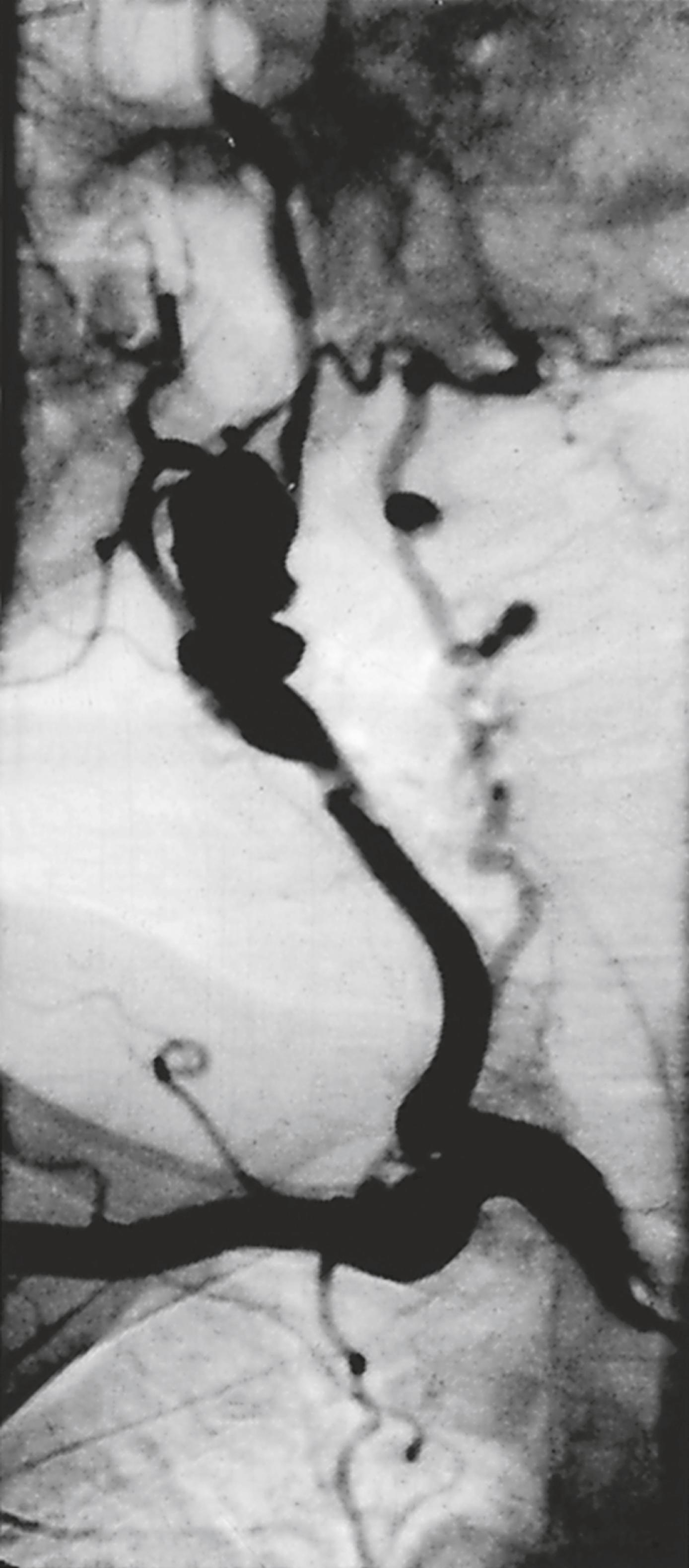 Figure 10.2, Example of fibromuscular dysplasia causing early aneurysm formation in the carotid artery.