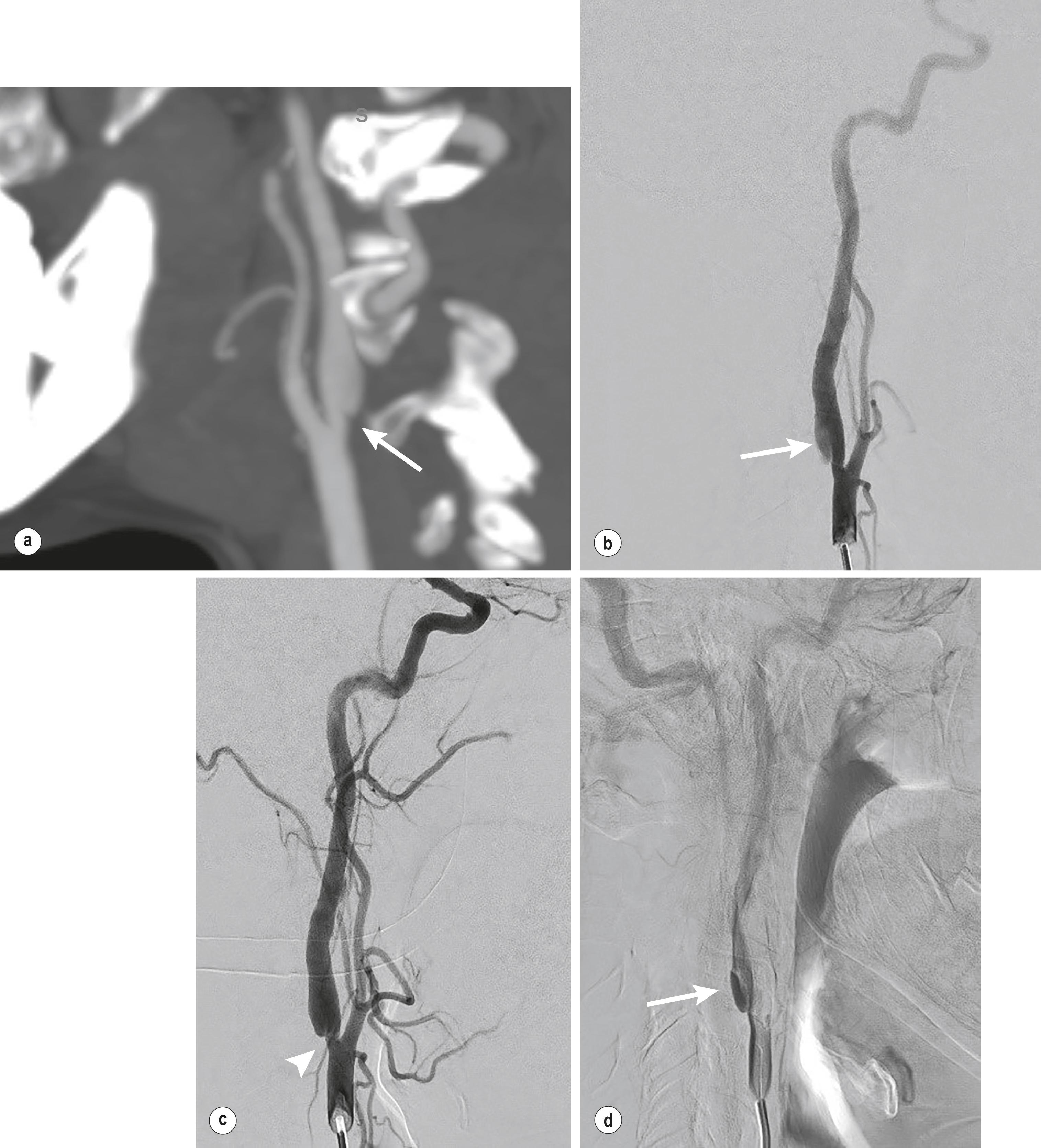 Figure 10.3, (a) Sagittal MPR image of computed tomographic angiography showing diaphragmatic lesion in the proximal segment of the left internal carotid artery (ICA) ( arrow ), indicative of the presence of a carotid web. (b) Angiographic image of selective digital subtraction angiography (DSA) of left common carotid artery (CCA) in early phase demonstrating slow filling of the space behind the carotid web ( arrow ). (c) Selective DSA showing only ‘diaphragmatic’ lesion at the level of the carotid bulb ( arrowhead ), indicating the carotid web. (d) Selective DSA late phase showing stagnation of contrast in the ‘pouch’ created by the carotid web ( arrow ).