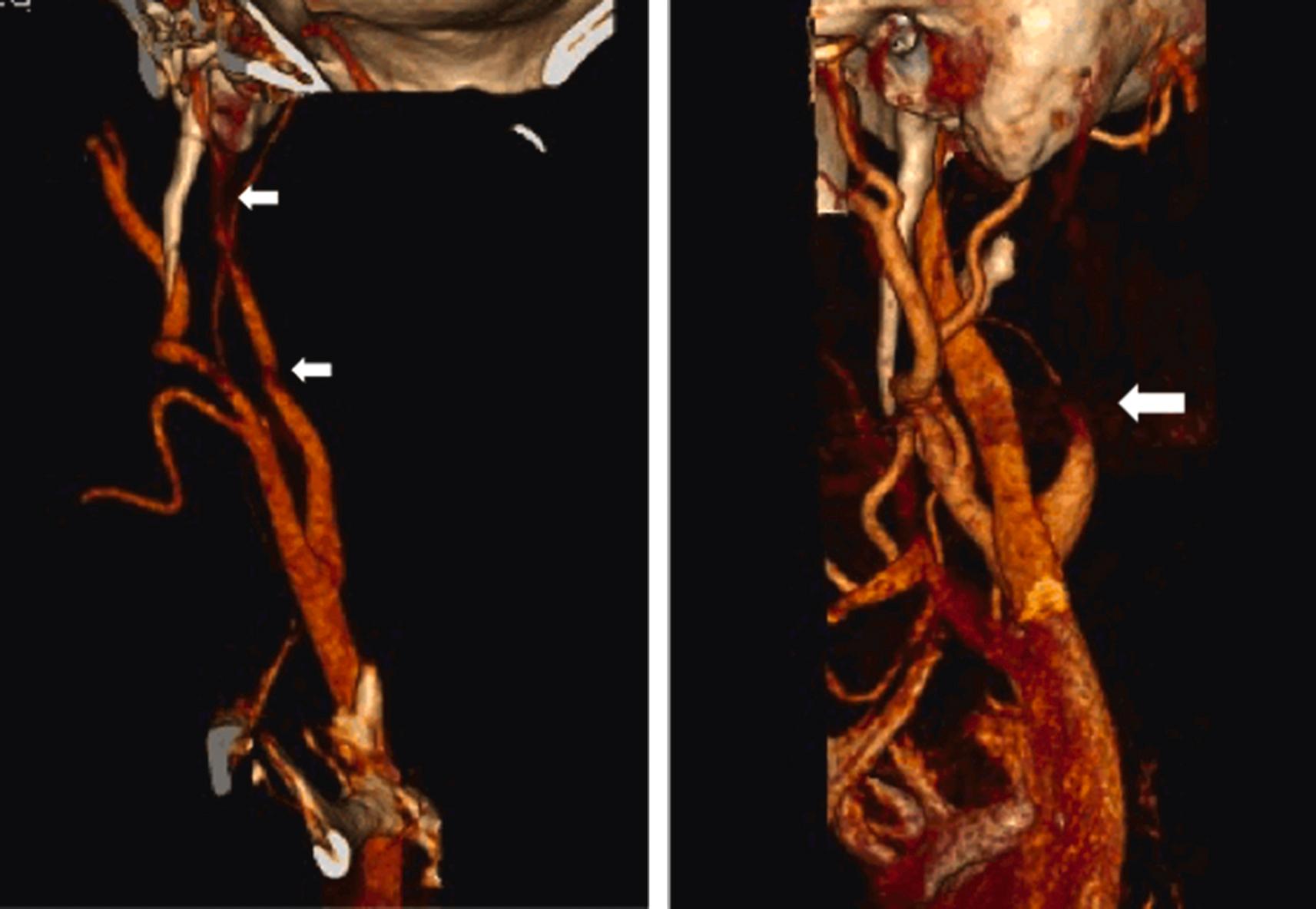 Figure 10.4, Three-dimensional computed tomographic angiography (CTA) reconstruction showing bilateral carotid dissections in the same patient. Left panel shows asymptomatic, spontaneous internal carotid artery (ICA) dissection (type 1 lesion) with entry and exit tears ( small arrows ), causing no significant stenosis. Right panel: symptomatic ‘flame’-shaped type 3 dissection with sub-occlusion of the ICA, 2–3 cm beyond the bifurcation.