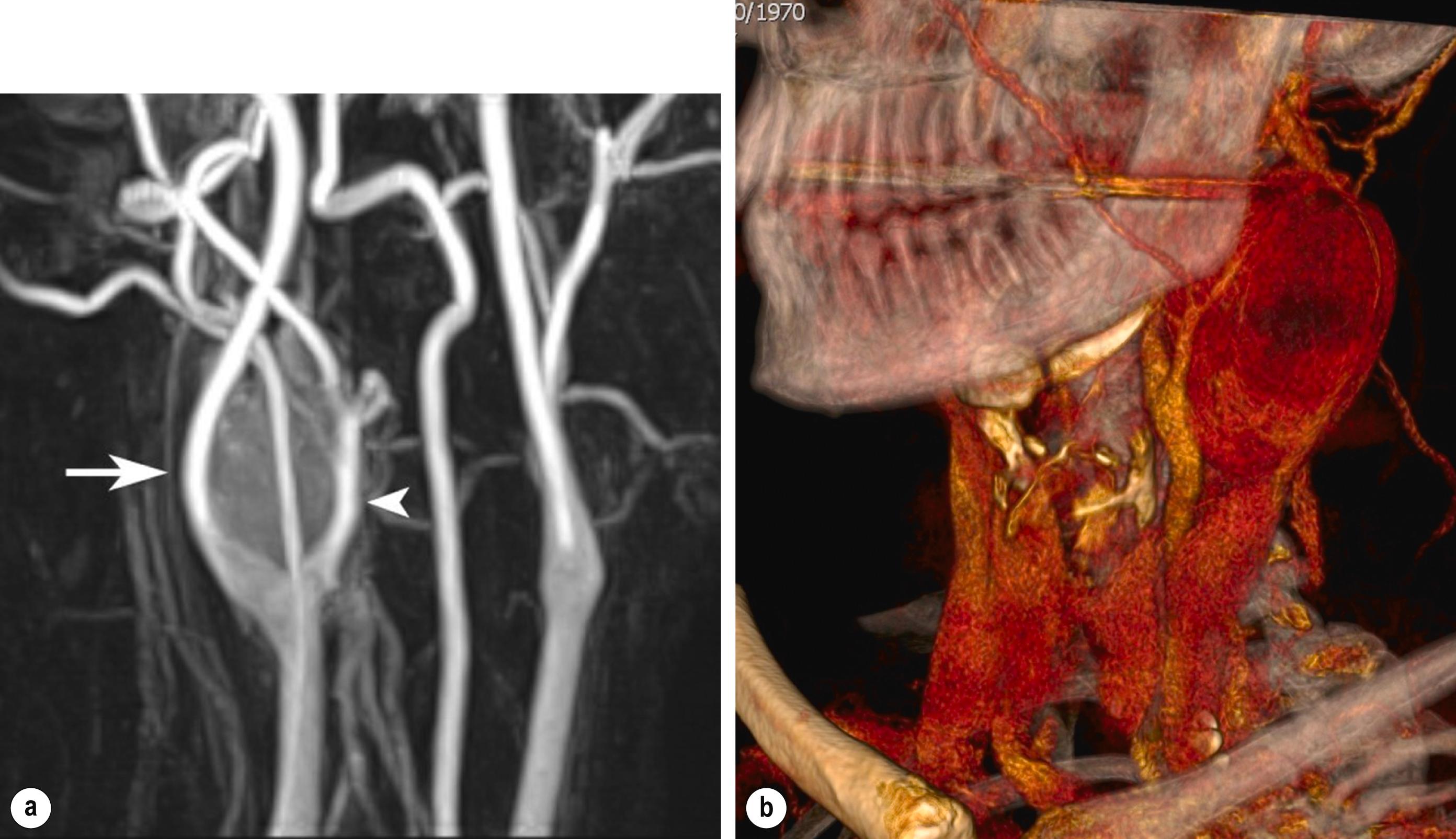 Figure 10.5, (a) Maximum intensity projection reconstruction of magnetic resonance angiography (MRA) of a highly vascular right carotid body tumour causing splaying of the bifurcation (right internal carotid, arrow ; right external carotid artery, arrowhead ). (b) Three-dimensional computed tomography angiogram of a probable glomus vagale tumour. Note that the tumour does not splay the bifurcation, but it pushes between the external and internal carotid arteries from a posterior location higher up in the neck.