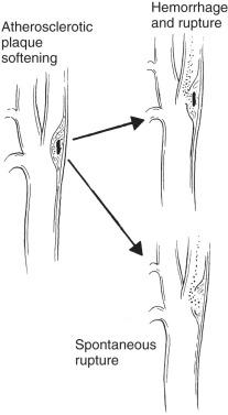 FIG 19.11, Atherosclerotic Plaque Undergoing Central Softening.