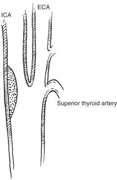 FIG 19.2, The common carotid artery bifurcation, the most common site for atherosclerotic plaque deposition, is located on the wall opposite the divider. ECA, External carotid artery; ICA, internal carotid artery.