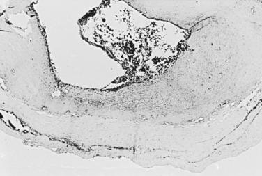 FIG 19.3, Microscopic section of an atherosclerotic plaque removed from the carotid bifurcation. Notice the fibro-intimal proliferation with cholesterol cleft formation. Thrombotic material is adherent to the luminal surface of the plaque.
