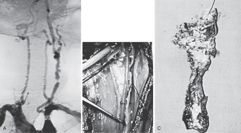 FIG 19.5, (A) Arch angiogram demonstrating carotid artery disease secondary to external cervical radiation. Note complete occlusion of the right common carotid artery. Multiple stenoses are in the left common carotid artery, an unusual site for primary atherosclerosis. (B) Operative appearance of the lesion secondary to external radiation. (C) Intimectomy specimen of the lesion produced by external cervical radiation.