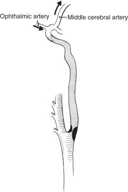 FIG 19.6, Occurring distal to an occlusive lesion of the internal carotid artery. Note that the column of thrombus stops short of the ophthalmic artery, and patency of the middle cerebral artery is maintained.