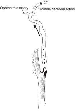 FIG 19.8, Emboli released from a plaque strategically placed at the origin of the internal carotid artery can pass into the middle cerebral artery and lodge in the terminal branch. This results in either a temporary or a permanent neurologic deficit in the distribution appropriate to the arterial occlusion.