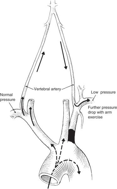 FIG 19.9, Mechanism of the Subclavian Steal Syndrome.