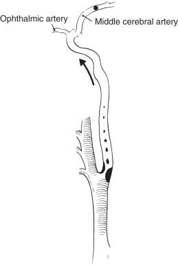 FIG 19.10, Embolic Fragment in the Middle Cerebral Artery.