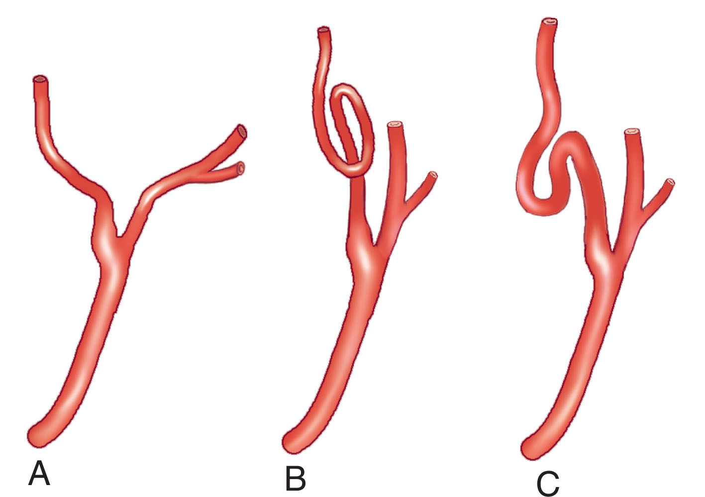 Fig. 37.2, Morphologic variations in the internal carotid artery.