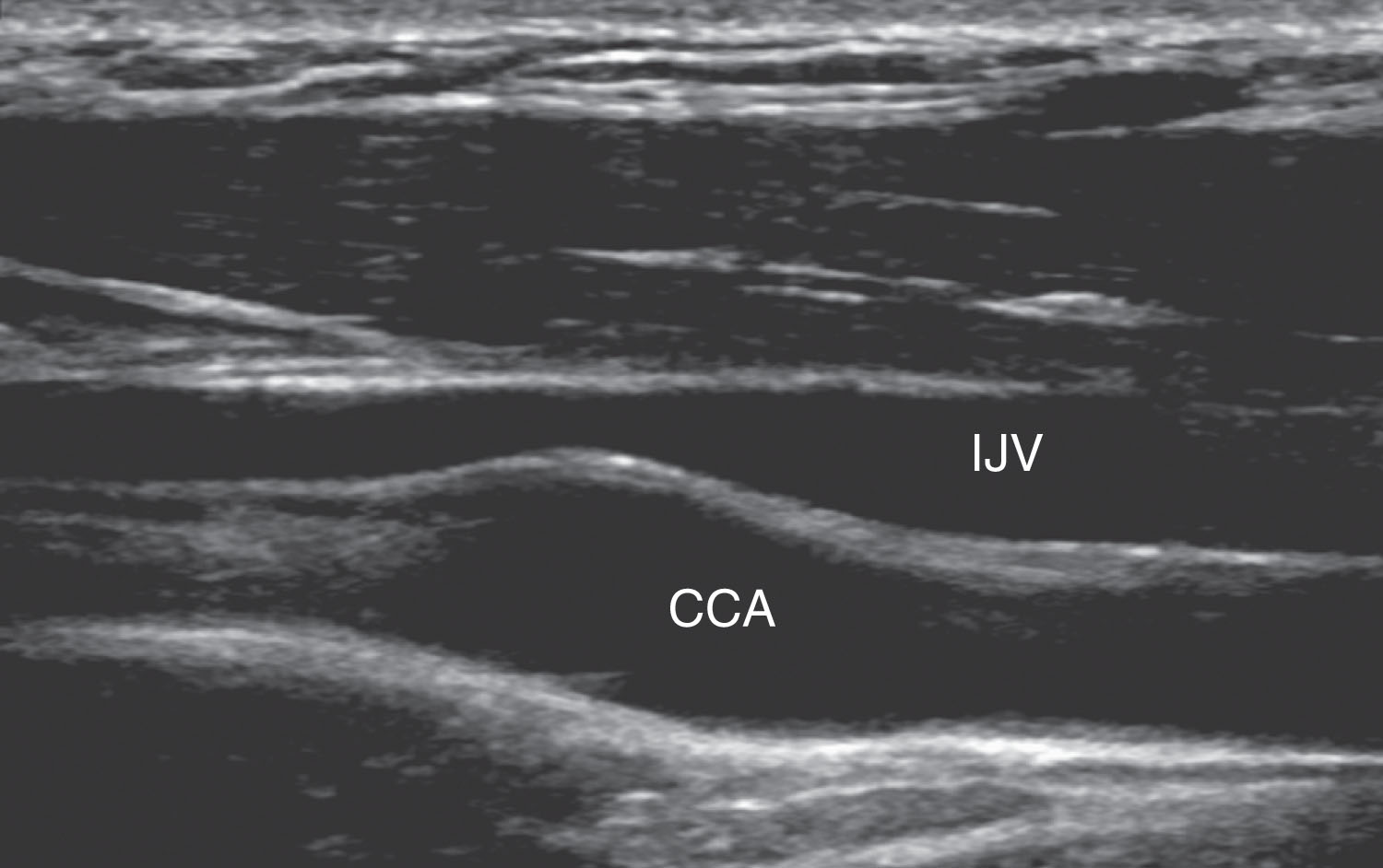 Fig. 37.3, Longitudinal gray-scale image of a normal common carotid artery (CCA) in which the internal jugular vein (IJV) can be seen anterior to the CCA.