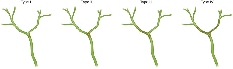 Figure 55-2, Bismuth classification for tumors of the hepatic duct bifurcation.