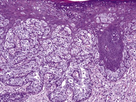 FIG. 3.2, Extramammary Paget disease. Neoplastic cells with abundant cytoplasm are arranged in confluent nests and as single cells throughout the epidermis.