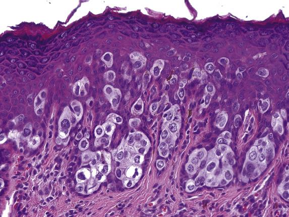 FIG. 3.3, Extramammary Paget disease. The clusters of Paget cells compress the basal keratinocytes against the basement membrane.