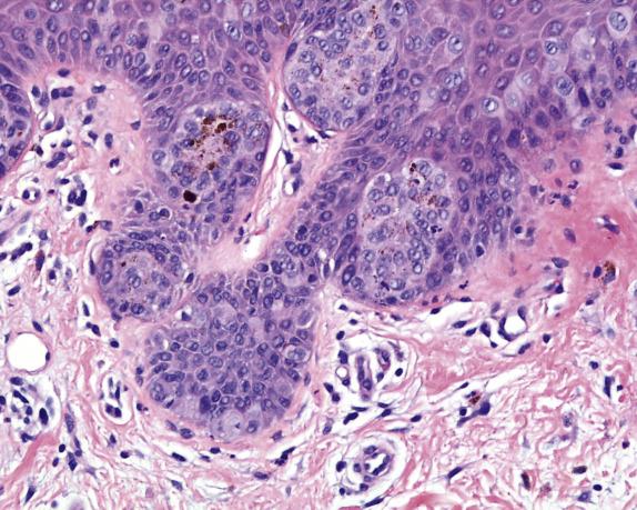 FIG. 3.4, Extramammary Paget disease. Paget cells show some intracytoplasmic melanin transferred by epidermal melanocytes.