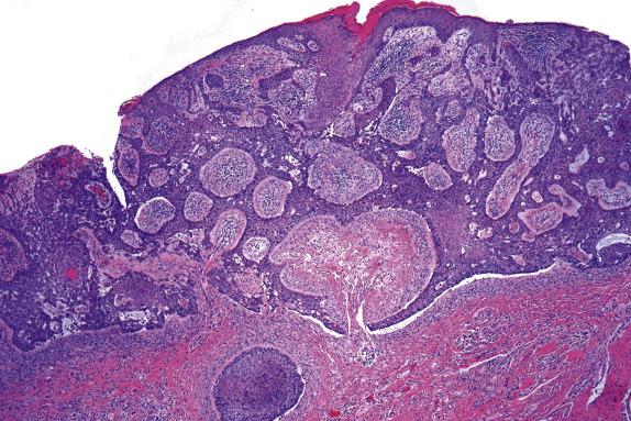 FIG. 3.5, Extramammary Paget disease. Prominent irregular pseudoepitheliomatous hyperplasia associated with chronic inflammation may raise concern at low power for invasive squamous cell carcinoma.