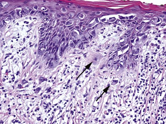 FIG. 3.6, Extramammary Paget disease. Single neoplastic cells (arrows) are infiltrating the superficial dermis (<0.1 cm).