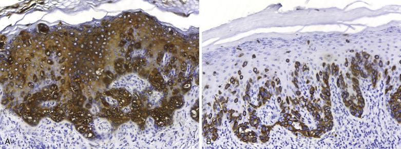 FIG. 3.7, Primary extramammary Paget disease. The neoplastic cells are positive for mCEA (A) and CK7 (B).