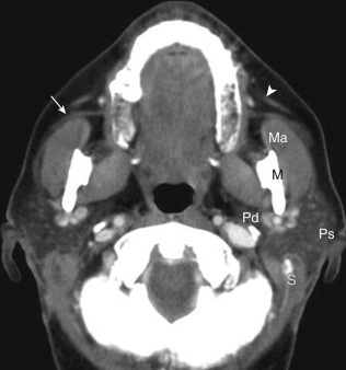 FIGURE 14-1, Normal parotid anatomy. Computed tomography (CT): The plane between the styloid process (S) and the mandible (M) defines the superficial portion of the parotid gland (Ps) from its deep portion (Pd) on CT. The parotid duct (white arrow) on the right is distinguished from the zygomaticus muscle (white arrowhead) on the left. Note parotid tissue superficial to the masseter muscle (Ma).