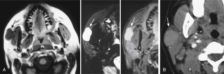 FIGURE 14-11, Pleomorphic adenoma. A, T1-weighted imaging (T1WI), T2WI, and enhanced T1WI scans from left to right show a typical pleomorphic adenoma (arrows), well-defined, very bright on T2WI, and enhancing homogeneously. B, The well-defined nature is also seen on a computed tomography scan. On delayed scanning the pleomorphic adenoma accumulates more and more contrast even as the vascular opacification fades (not shown).