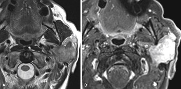 FIGURE 14-12, Meet the ex: carcinoma ex pleomorphic adenoma, that is. A, Axial T2-weighted image (T2WI) shows a heterogeneous signal mass replacing most of the left parotid gland. B, The mass enhances on postcontrast fat-suppressed T1WI. On resection, carcinoma was seen arising from a pleomorphic adenoma histopathologically.