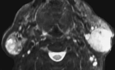 FIGURE 14-13, Warthin tumor. This T2-weighted image shows bilateral masses with heterogeneous mixed signal.