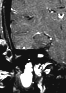 FIGURE 14-14, Facial nerve schwannoma. This schwannoma ascends up the intramastoid portion of the facial nerve on this postgadolinium T1-weighted coronal scan.