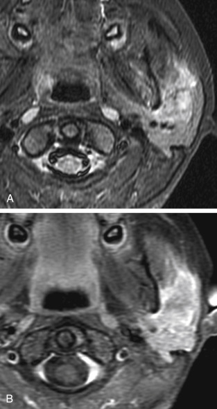 FIGURE 14-15, Mucoepidermoid carcinoma. A, Axial T2-weighted imaging (T2WI) scan shows a poorly defined heterogeneous signal lesion in the parotid gland focally invading the adjacent masseter and pterygoid musculature. B, Axial fat-suppressed contrast-enhanced T1WI shows heterogeneous enhancement in the mass as well as the invasive component in the masseter muscle. Invasive mass in the parotid in a kid? ...Best guess is mucoepidermoid carcinoma, which this turned out to be.