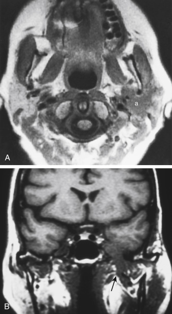 FIGURE 14-16, Adenoid cystic carcinoma of the parotid gland. A, T1-weighted imaging of the left parotid shows infiltrative mass (a) extending into both superficial and deep portions of the gland. Note how well the mass is identified by the replacement of the normal high intensity parotid tissue. Better watch cranial nerve VII on this lesion. Mind your facials! B, Woops! There it goes up the foramen ovale (arrow) coursing along the mandibular nerve. How did it get there? The auriculotemporal branch of V 3 , which is in close proximity to VII branches. Fooled you!