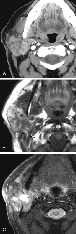 FIGURE 14-17, Squamous cell carcinoma of the parotid gland. A, Postcontrast axial computed tomographic image in a patient with facial swelling and history of right periauricular squamous cell carcinoma shows an infiltrative mass nearly completely replacing the right parotid gland. B, Axial T1-weighted image (T1WI) and (C) T2WI show the same infiltrative lesion. Note that some T1 dark tumor is sneaking back toward the stylomastoid foramen (arrow), very worrisome for facial nerve extension.