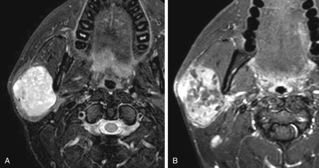 FIGURE 14-18, Acinic cell carcinoma. A, Axial T2-weighted image (T2WI) shows a well circumscribed mass in the right parotid gland. So you’re thinking pleo, right? B, The mass enhances heterogeneously on T1WI. This turned out to be acinic cell carcinoma. Thank goodness for FNAs!