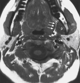 FIGURE 14-19, Normal masticator space. Masseter muscle (m), pterygoid muscle (p), and angle of the mandible (a) are well visualized on this T1-weighted imaging scan. Note that a masticator space lesion would displace parapharyngeal fat (arrows) medially and predominantly posteriorly.