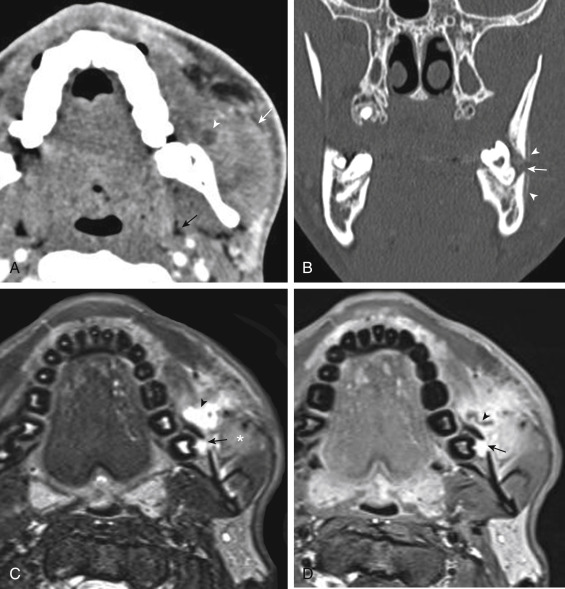 FIGURE 14-20, A plea to brush regularly. A, Axial contrast-enhanced computed tomography (CT) shows marked fullness of the left masseter muscle (white arrow) with low density, possibly necrotic component (arrowhead) . There is also fullness of the pterygoid musculature resulting in displacement of the parapharyngeal fat (black arrow) . Could this be a tumor? B, Coronal CT shows periapical lucency surrounding the left mandibular molar tooth, with dehiscence of the buccal cortex (arrow) and periosteal reaction along the mandibular ramus (arrowheads) . Hmmm, this looks like a case of dental infection gone really bad, with extraosseous extension into the masticator soft tissues, abscess in the masseter, and osteomyelitis of the mandible. C, Axial T2-weighted and (D) postcontrast T1-weighted images show the sinus tract from mandible to overlying soft tissues (arrows), as well as the abscess (arrowhead) and edema ( asterisk in C) in the masseter muscle.