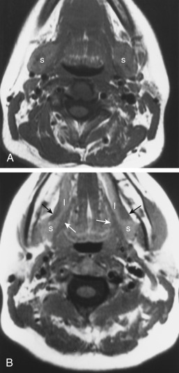 FIGURE 14-2, Normal submandibular-sublingual anatomy. A, Submandibular glands (s) can be seen on this T1-weighted image in the neck. Note that there normally is some heterogeneity to the gland because of its hilum and ductal system. B, Superior portion of the submandibular gland (s) can be seen on this section, which also nicely demonstrates the sublingual gland tissue (l). Note that the sublingual space is bounded by the mylohyoid musculature (black arrows) laterally and the styloglossus-hyoglossus complex (white arrows) medially.