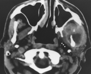 FIGURE 14-21, Abscess in masticator space. Axial computed tomography shows an abscess (a) centered on the left mandible. Note that the parapharyngeal fat (asterisks) is displaced posteromedially by this masticator space infection.