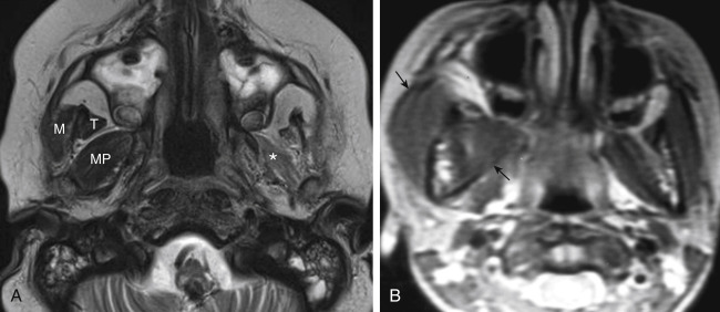 FIGURE 14-22, A, Axial T2-weighted image in a young child with metastatic medulloblastoma involving the trigeminal nerve intracranially. There is marked atrophy of the left muscles of mastication (asterisk) due to V3 disease. Compare to the normal bulk of the medial pterygoid (MP), and the insertions of the temporalis (T) and masseter (M) muscles on the right. B, The muscles (arrows) on the right in a different patient are larger than the left. This could be from malocclusion or a glycogen storage disease infiltration.