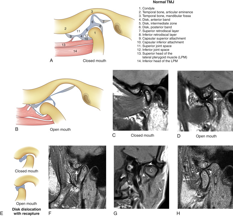 FIGURE 14-23, Normal temporomandibular joint (TMJ) anatomy and disk derangements. Schematic of the TMJ in sagittal oblique plane demonstrates normal anatomic relationships in the (A) closed- and (B) open-mouth positions. Note how the mandibular condyle translates forward anteriorly on mouth opening to allow for disk recapture. C, Sagittal oblique proton density (PD) image in closed-mouth position shows the mandibular condyle (C), articular eminence (E), and normal disk position (asterisk) relative to these structures. D, Sagittal oblique PD image in the open-mouth position shows the normal position of the articular disk (asterisk) juxtaposed between the articular eminence (E) and condyle (C), indicating appropriate recapture of the disk. The posterior band (white arrow), superior retrodiskal later (white arrowhead), as well as superior (black arrowhead) and inferior capsular (black arrow) attachments, are shown. E, Schematic representation of anterior disk dislocation on closed mouth view with appropriate recapture despite the dislocation on mouth opening. F, PD image in closed-mouth position shows a thinned irregular anteriorly displaced disk (arrow) relative to the condyle (C). Note relationship of the disk to the articular eminence (E). G, A coronal T1-weighted image shows that the disk (between arrowheads) is also medially dislocated relative to the condylar head (C). H, On mouth opening, despite its degenerative appearance, this disk (between arrowheads) does recapture appropriately between the condyle (C) and eminence (E). I, Schematic representation of anterior disk dislocation on closed-mouth view without appropriate recapture on mouth opening. Note how the condyle shows very limited anterior translation, giving the “locked” appearance. J, PD image shows anteriorly displaced irregular disk on closed-mouth position (arrow). The eminence (E) and condyle (C) position are noted. Note the osteophyte at the joint space (arrowhead) that’s got to be very annoying. K, Sagittal oblique T2 image shows the same anteriorly displaced disk (arrowhead), condyle (C), and eminence (E) on closed-mouth view. There is joint fluid present (arrow), which can correlate with patient pain. L, On mouth opening, the pesky osteophyte (arrowhead) limits anterior translation of the condyle (C), and the displaced disk (arrow) does not recapture. Eminence indicated by E.