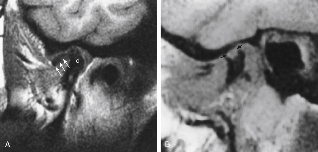 FIGURE 14-24, Avascular necrosis of the temporomandibular joint (TMJ). A, Sagittal T1-weighted imaging (T1WI) shows decreased intensity in the mandibular condyle (c) in this patient with chronic TMJ syndrome. Note that the disk (arrows) is anteriorly dislocated in this closed mouth view. This patient had avascular necrosis of the condyle, confirmed by wedge resection. B, Erosive synovitis of the TMJ. Note the erosion (arrows) of the condylar head on the sagittal T1WI in this patient with rheumatoid arthritis.