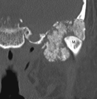 FIGURE 14-25, Calcified lesion of temporomandibular joint. This temporomandibular joint lesion shows a calcified matrix and destruction of the temporal bone making up the glenoid fossa. The differential diagnosis would include synovial chondromatosis, a chondrosarcoma, a chondroblastoma, calcium pyrophosphate dihydrate deposition disease, tumoral calcinosis, and Brown tumor, in decreasing order of likelihood. Final diagnosis: synovial chondromatosis.