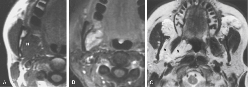 FIGURE 14-26, Venous vascular malformation of the masticator space. Note how this mass (N) that is isointense to muscle in A enhances so dramatically in B. C, Different case, and same diagnosis: T2-weighted imaging shows infiltrating venous vascular malformations (h).