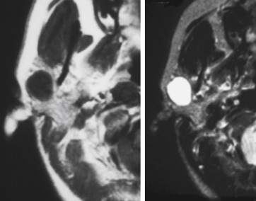 FIGURE 14-3, First branchial cleft cyst (BCC). This intraparotid cyst with a sharply defined wall is dark on T1-weighted imaging (T1WI) (to the left) and very bright on T2WI (image on the right). There is no way of knowing whether this is an inflammatory cyst, a posttraumatic sialocele, or a BCC based on imaging alone.