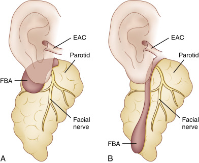 FIGURE 14-4, First branchial cleft cyst’s Arnot types. A, Type I first branchial cleft anomaly (FBA). The cyst is located in the parotid gland. There is no communication with the external auditory canal (EAC). B, Type II first FBA. The proximal portion of the anomaly communicates with the EAC. The cyst tract typically extends inferiorly within the deep lobe of the parotid gland. The main portion of the cyst is usually located inferior to the parotid gland. Consequently, these masses may present as submandibular masses.