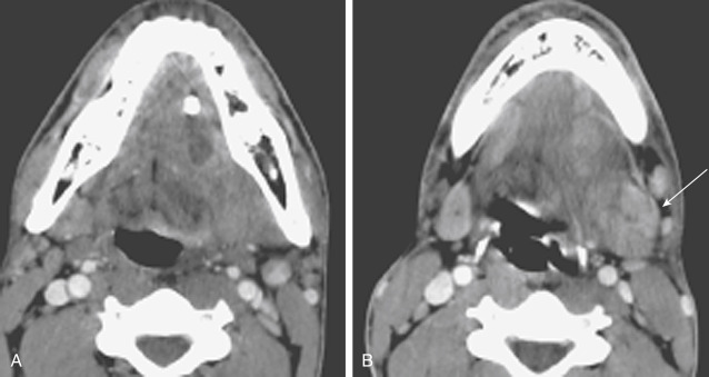 FIGURE 14-5, Submandibular sialadenitis. A, A large stone with a dilated Wharton duct is seen in the left sublingual space. B, Note the swollen submandibular gland (arrow) with the effaced sublingual space fat planes.