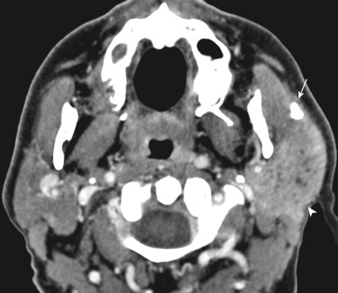 FIGURE 14-6, Parotid sialolithiasis and parotitis. That is a big stone (arrow) in a small Stenson duct. Note how much larger and relatively hyperenhancing the inflamed left parotid gland (arrowhead) is when compared with the right.