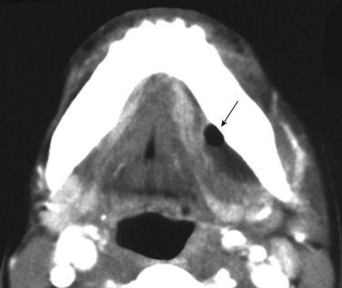 FIGURE 14-7, Abscess. An abscess in the sublingual space is usually a result of carious teeth or treatment for such. A pocket of air and fluid is marked by the arrow . This is what happens when dentists do not wash their instruments of torture properly.